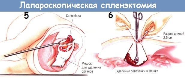 Splenectomy. Consequences for the body, as the operation is called, diet, rehabilitation