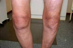 knæets artrose