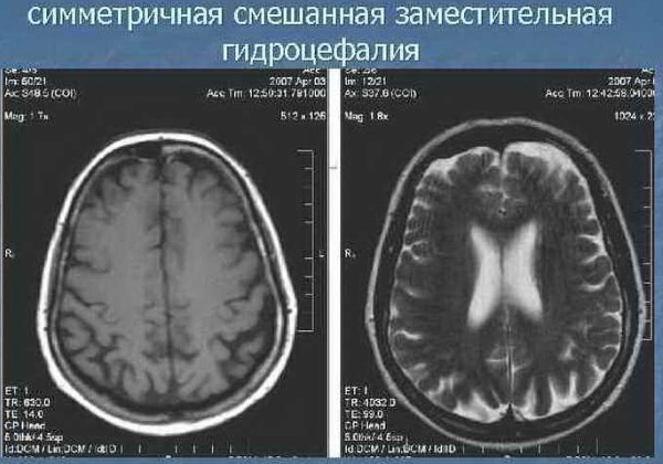 Väline aju asendav hüdrotsefaalia täiskasvanutel. Mis see on, prognoosi ravi