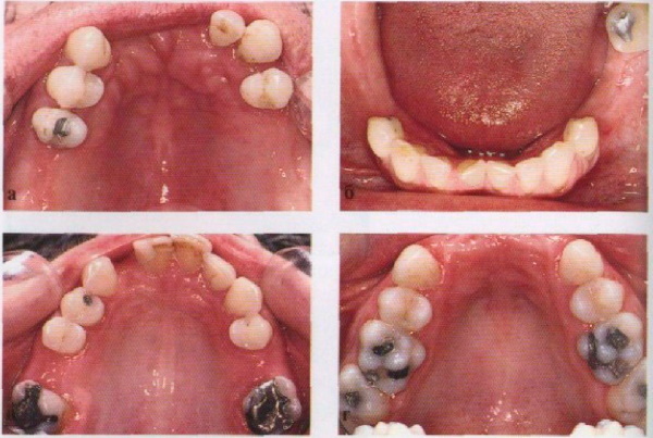 A fogászati ​​hibák Kennedy osztályozása. Ortopédia