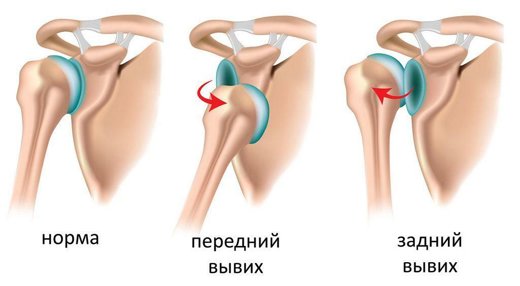 Deslocamento do ombro anterior e posterior