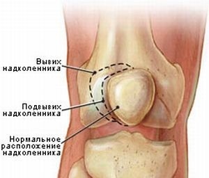 Subluxation of the knee