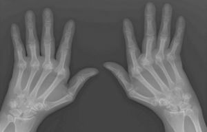reumatoïde artritis van de handen