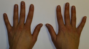 Mains après la chirurgie