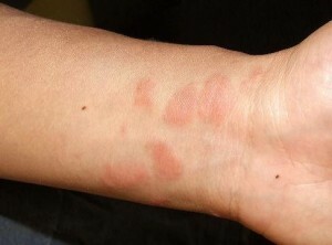 rash on the arm