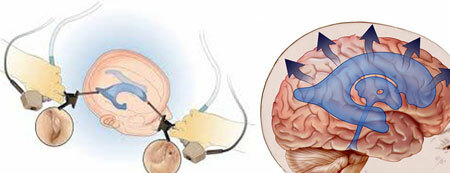 Treatment of hydrocephalus of the brain