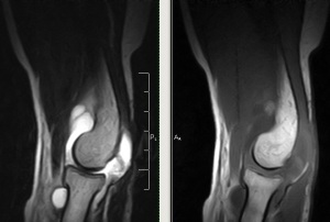 MRI of the elbow