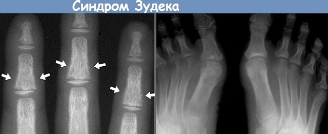 X-ray of the extremities