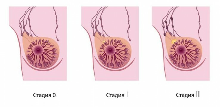 Stadier af brystkræft
