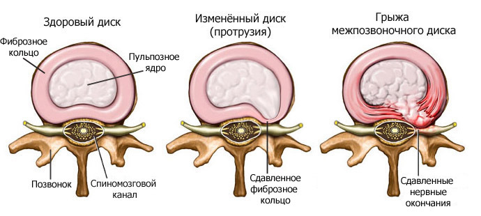Hernia i cervikal rygsøjlen: en række symptomer og behandlinger