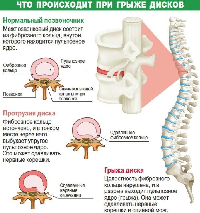 Disk hernia: gejala dan tanda, cara mengidentifikasi