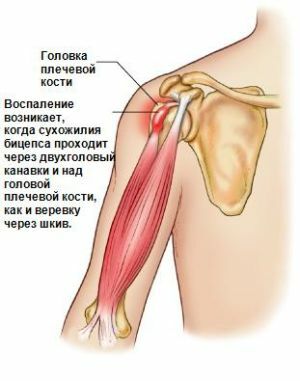 Tendonitis of the shoulder is an inflammation that can cause many causes
