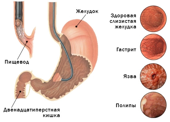 Obstruction of the stomach. Symptoms and treatment in adults