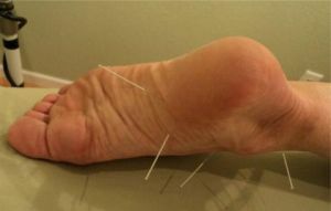 Duri di kaki dan tumit: alasannya dangkal, perawatannya rumit