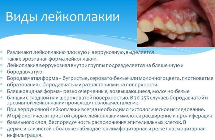 Leukoplakia ústnej dutiny. Foto, diferenciálna diagnostika