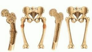 osteomalakia af knogler
