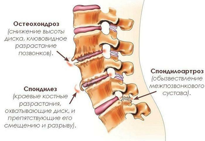 Osteochondróza je jednou z příčin vzniku intervertebrální kýly