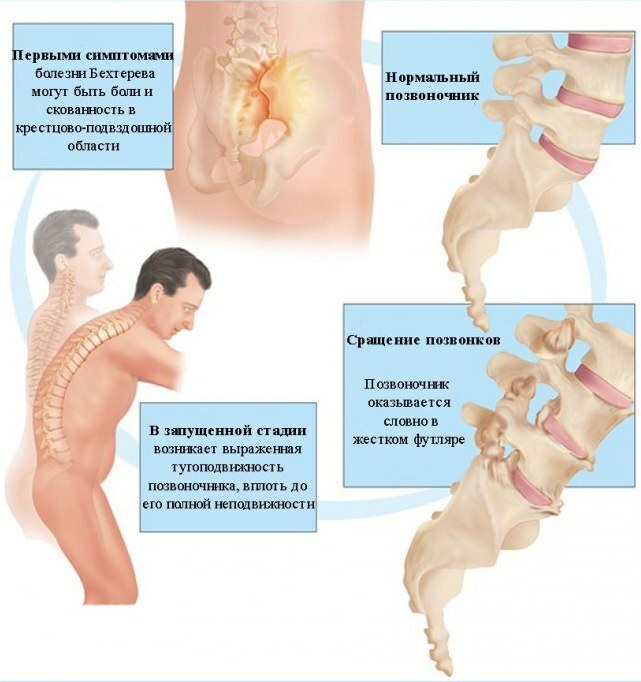 Ankylosing spondylitis. What is it, clinical guidelines, treatment, diagnosis