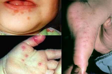 Symptoms of the Coxsackie virus in children