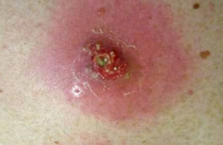 Inflamación purulenta única en la piel( absceso), foto