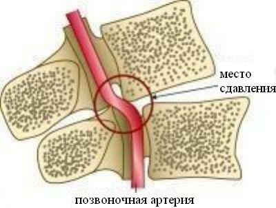Tvrzení arteria vertebrální s osteochondrózou
