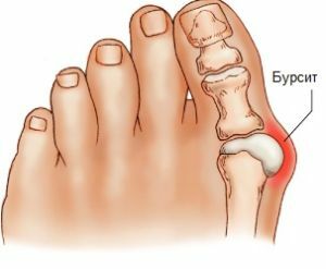 Bursitis of foot