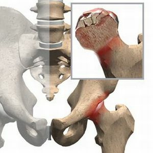 Inflammatory process in the head of the femur