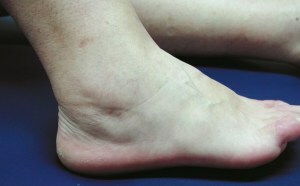 tendonitis of the foot