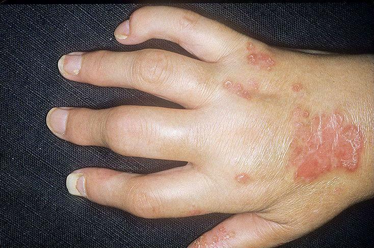 Inflammation of several joints at the same time, caused by the course of psoriasis, is called psoriatic polyarthritis