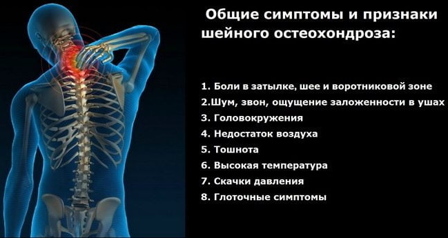 Cervical chondrosis. Symptoms and treatment, drugs