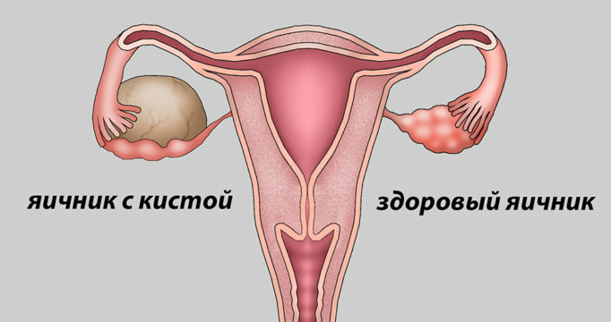 Causes of a cyst on the ovary