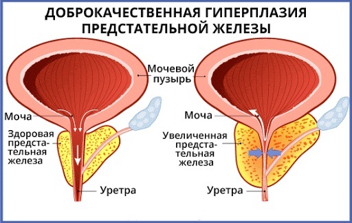 Sakrum sakit. Penyebab pada wanita saat hamil, pria saat duduk di kanan, di kiri, cara mengobati