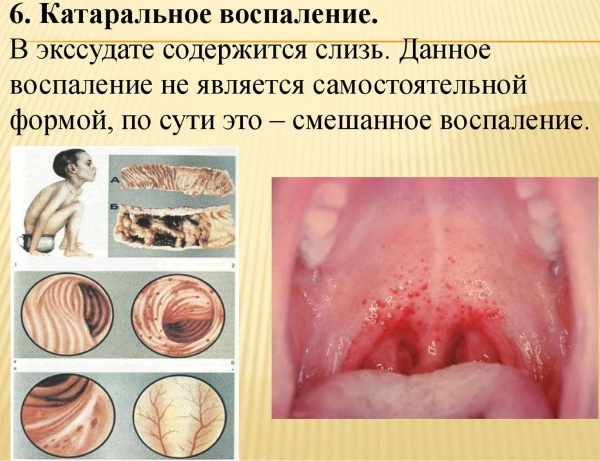 Catarrh. What is it, treatment of the upper respiratory tract, middle ear, sinuses