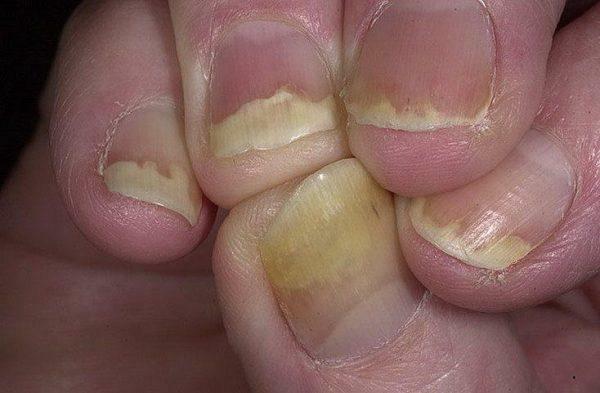 Bolezni nohtov na roki in njihovo zdravljenje