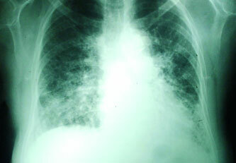 Stadier af sarkoidose i lungerne