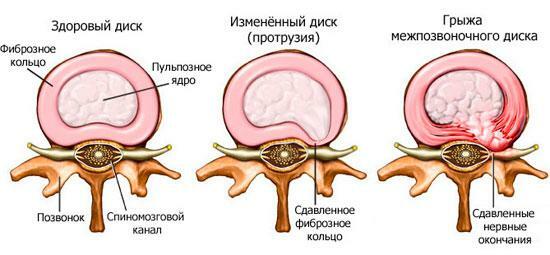 Dezvoltarea unui disc intervertebral herniat