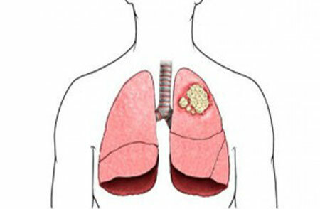 Rak płuca