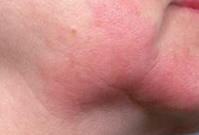 Kontakt dermatitis på ansigtsfoto