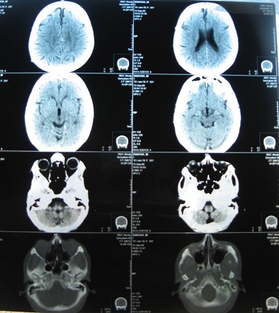 Encefalopatía residual del cerebro. Qué es, síntomas, cómo tratar, consecuencias.