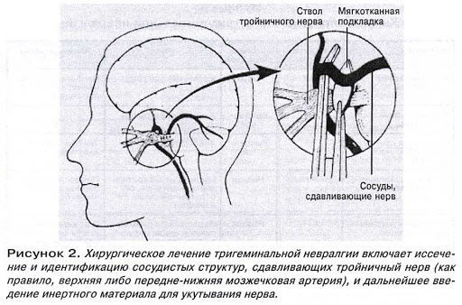 Neuralgia mięśniowa. Objawy i leczenie po lewej, prawej stronie