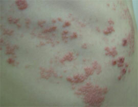 Treatment of skin diseases