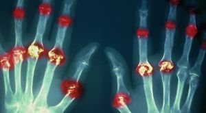artrite reumatóide das articulações das mãos
