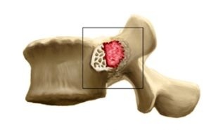 Osteoblastoma della colonna vertebrale