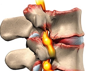 arthrose spinale à facettes