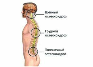 Locations of osteochondrosis of the spine