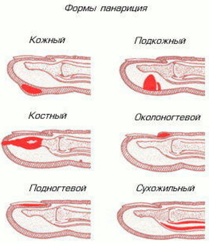 Panaritium des orteils. Symptômes et traitement