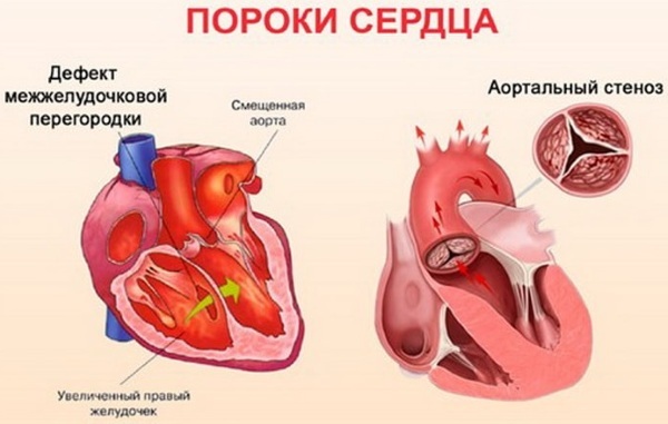 Hjertesykdommer. Liste, symptomer og behandling