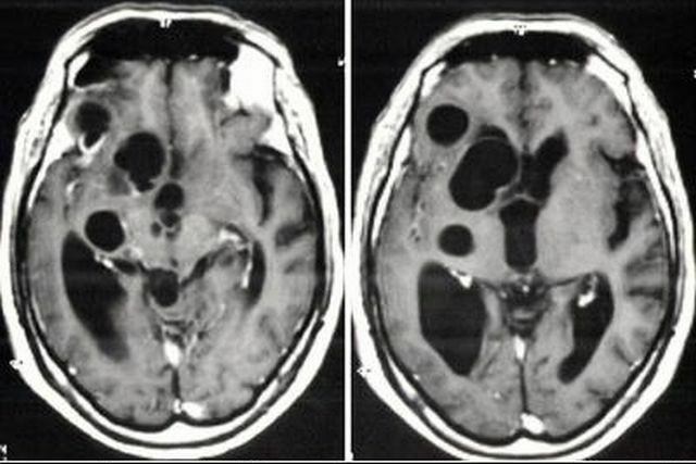 Was ist die retrozerebellare Zyste des Gehirns - Gefahr, Behandlung und Fotopathologie