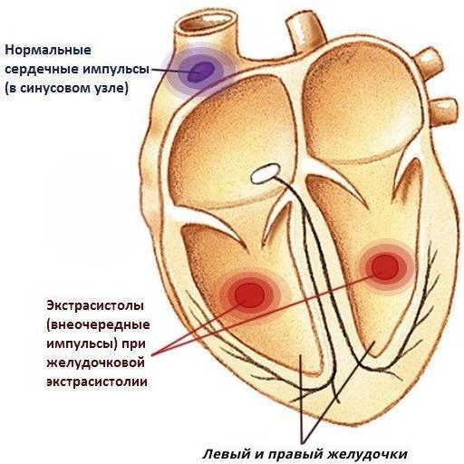 Extrasistole del cuore. Cause, sintomi, trattamento negli adulti, nei bambini