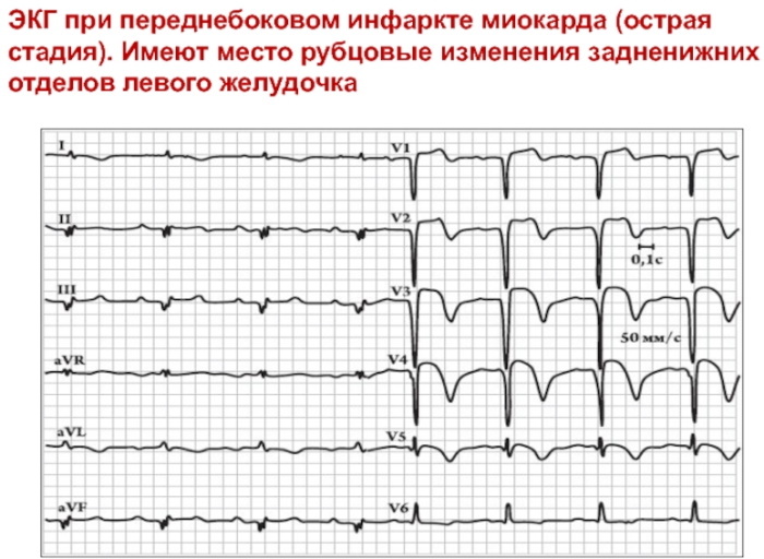 Ciktrciálne zmeny v myokarde na EKG